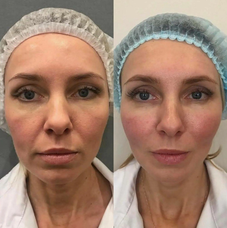 full face botox before and after